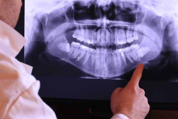 Best Emergency Dentist for Lost Fillings or Crowns in Baden, PA